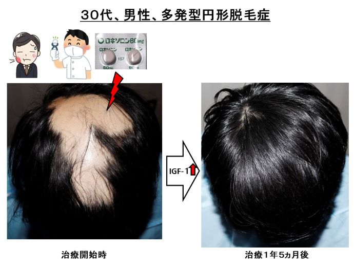 円形脱毛症　病院
